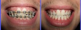 Which one is better: Invisalign or braces?