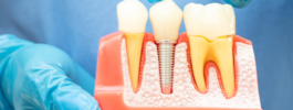 How to recover from a root canal treatment smoothly?