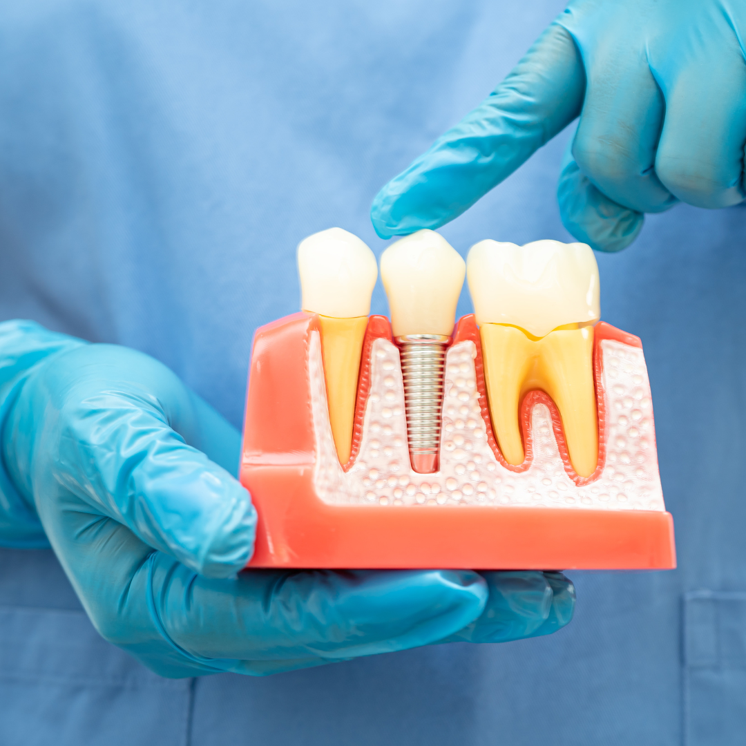 root canal treatment