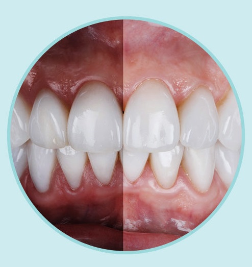 beforeafterblackgums